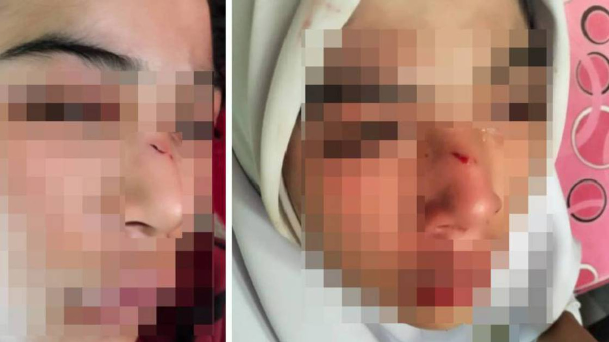 Kelantan Education Department Opens Investigation Into Alleged School Assault Leaving Teen With Fractured Nose and Shoulder