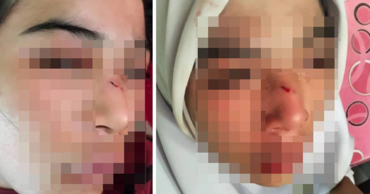 Kelantan Education Department Opens Investigation Into Alleged School Assault Leaving Teen With Fractured Nose and Shoulder