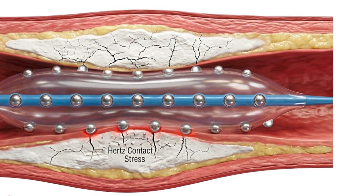 Malaysian cardiologists pioneer advanced technique for treating severely calcified heart arteries