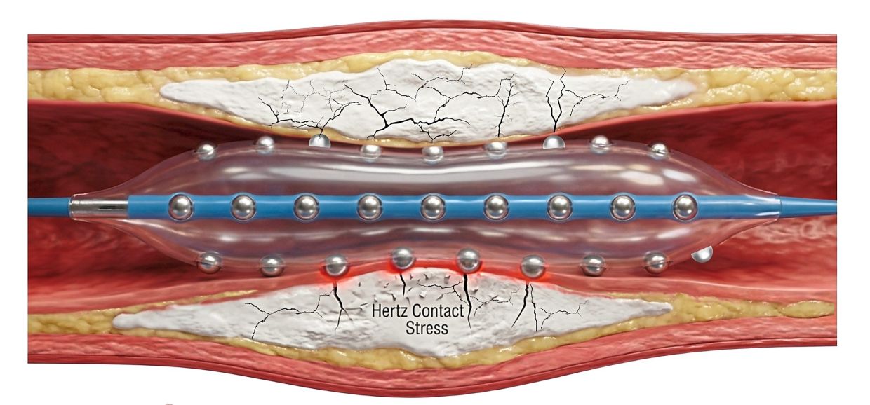 Malaysian cardiologists pioneer advanced technique for treating severely calcified heart arteries